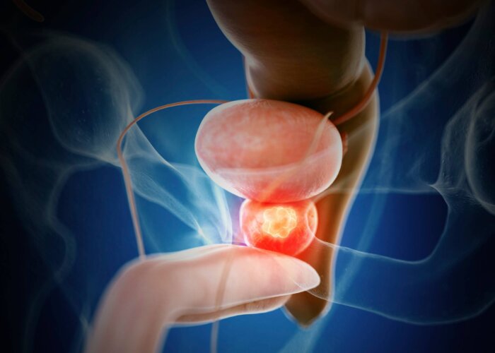 شناسایی ژن WNT9B به عنوان عامل ارثی در افزایش خطر سرطان پروستات